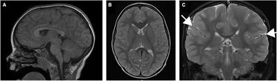 Novel loss of function mutation in TUBA1A gene compromises tubulin stability and proteostasis causing spastic paraplegia and ataxia